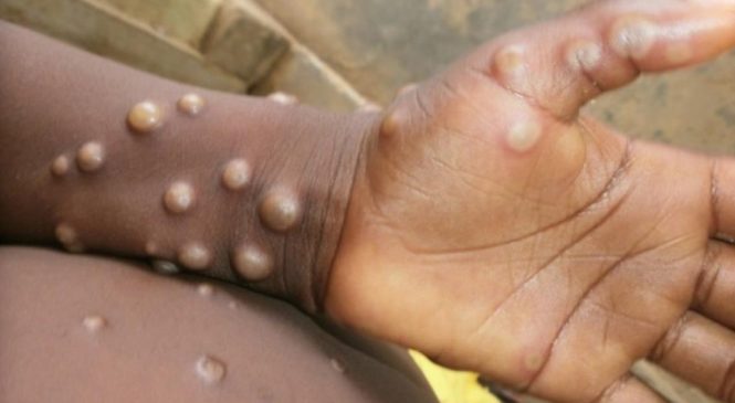 Não há urgência para vacinação contra varíola dos macacos, diz OMS