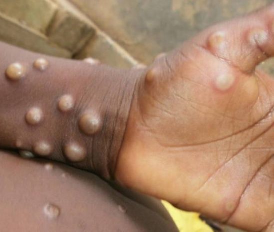Dois jovens estão sendo monitorados em Arapiraca com a varíola dos macacos