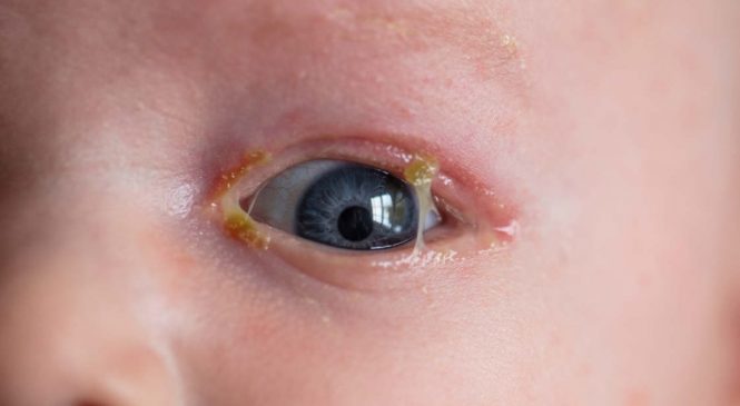 Conjuntivite neonatal pode levar à cegueira infantil